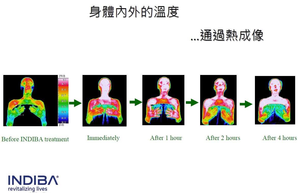 英特波後熱成像-台中INDIBA英特波推薦