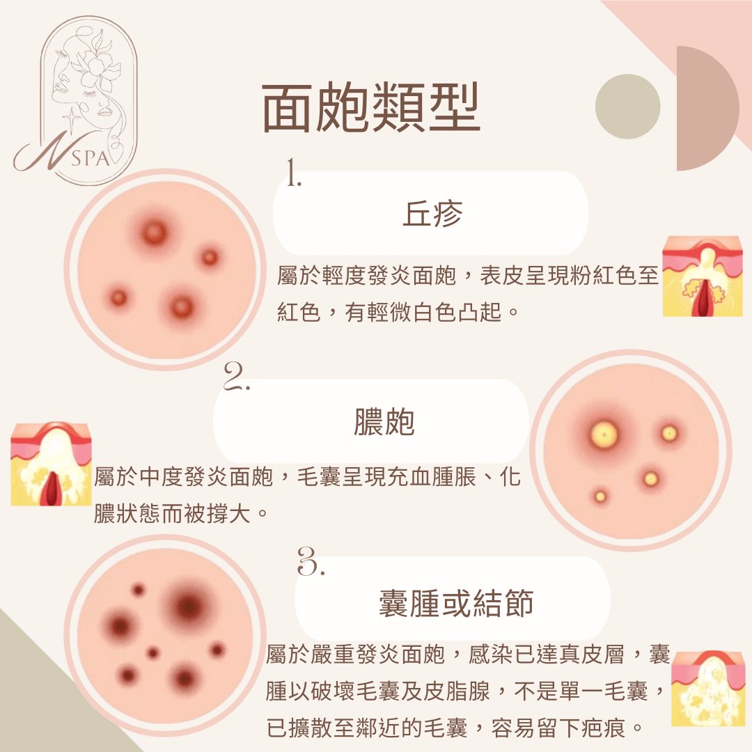 我的痘痘嚴重嗎?會不會留下疤痕呢?-N SPA