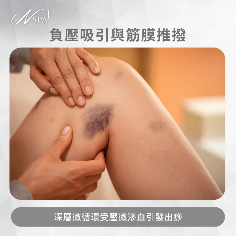 深層筋膜放鬆與負壓推撥-體雕為什麼會瘀青