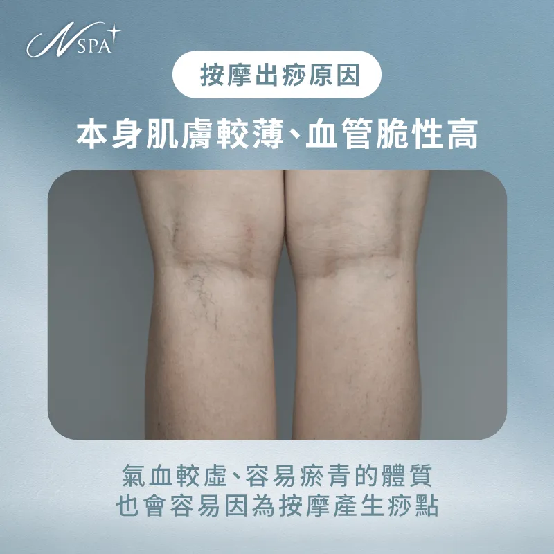 個人體質與出痧表現差異性也會影響按摩是否出痧 肌膚較薄-按摩 後 出痧